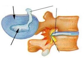 Distruzione dell'anello fibroso con osteocondosi cervicale