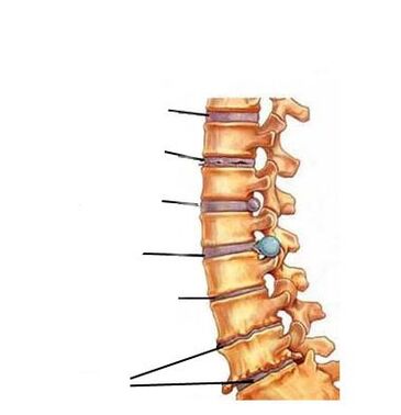 Fase di sviluppo dell'osteocondosi