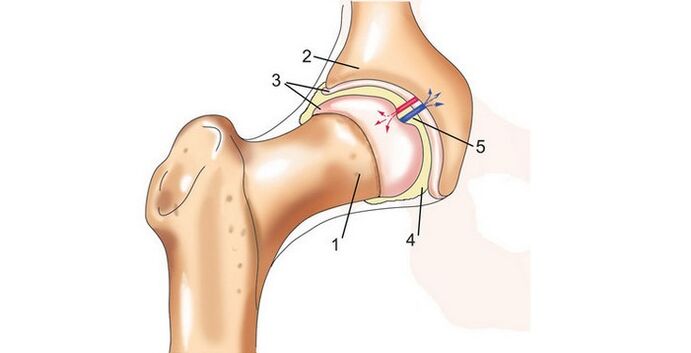 articolazione dell'anca e artrosi